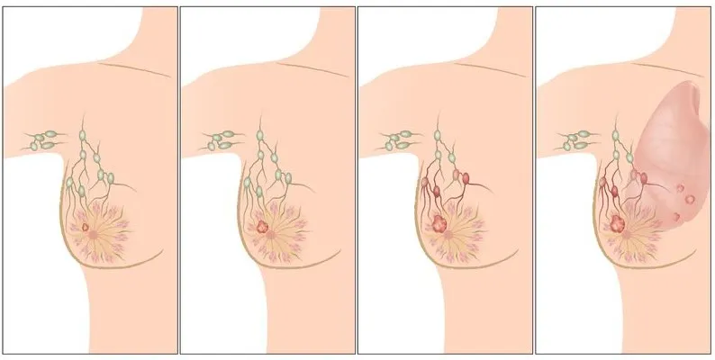 OP. DR. HALİT ÖZGÜL ANLATIYOR.. ‘MEME KANSERİ HAKKINDA A’DAN Z’YE BİLİNMESİ GEREKENLER’