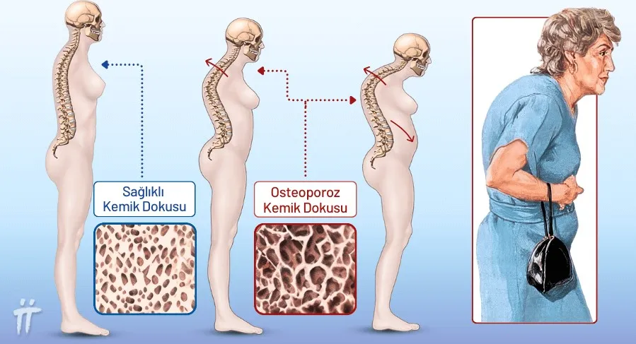 KEMİKLERİN SESSİZ DÜŞMANI ‘OSTEOPOROZ’ YAŞAM KAYBINA BİLE NEDEN OLABİLİYOR